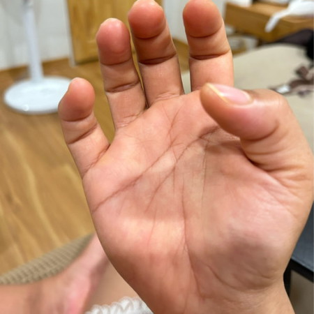 ปวดมือ มือชา นิ้วล็อกกำมือไม่ได้