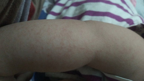 Bintik merah bayi 9 bulan