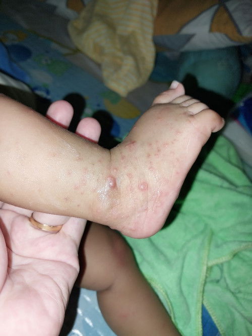 Tolong bantu share pengalaman ya mom bagi yang dedek atau mom sendiri pernah kena scabies