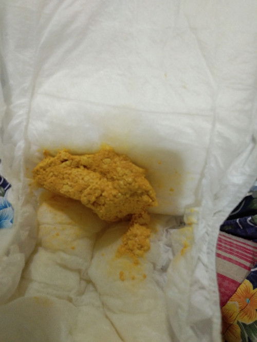 Feses bayi warna kuning kyk gini.dan bertektur ky beras.normal ga bun?mohon maaf sy ftokan fesesnya.