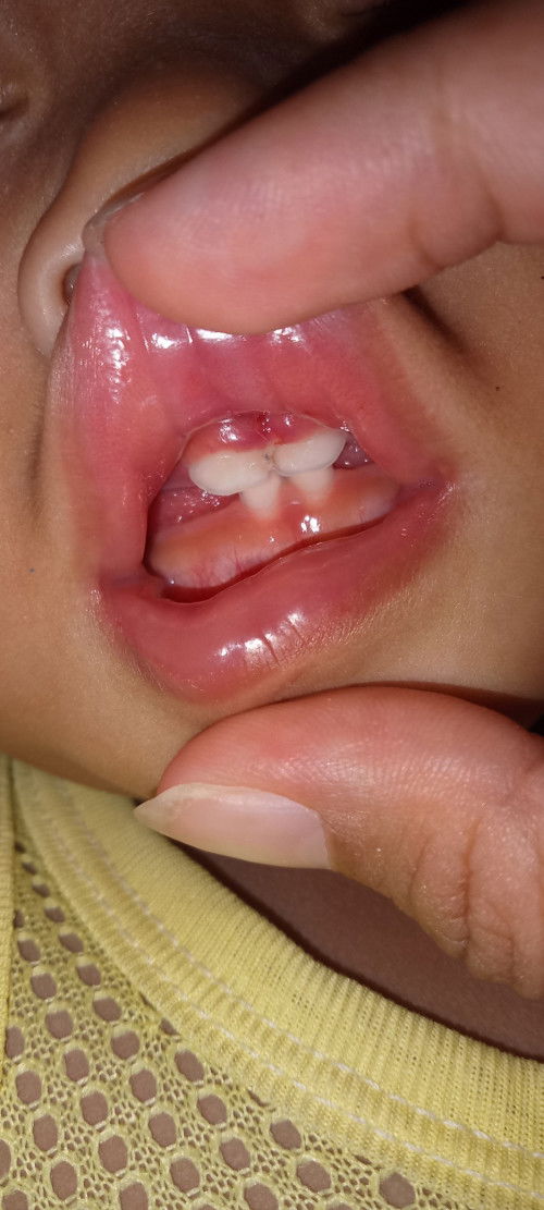 เส้นยืดร่องเหงือกฉีกขาด