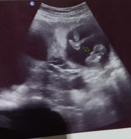 Baby gender