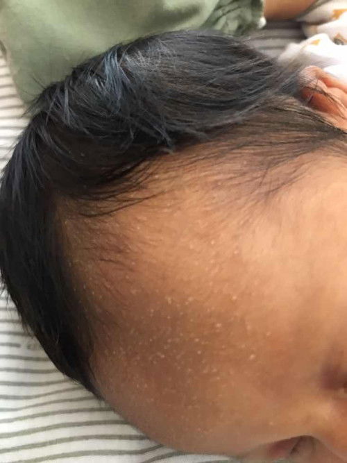 Bruntusan pada newborn