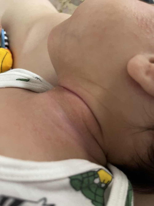 Should i be concerned with these rashes?