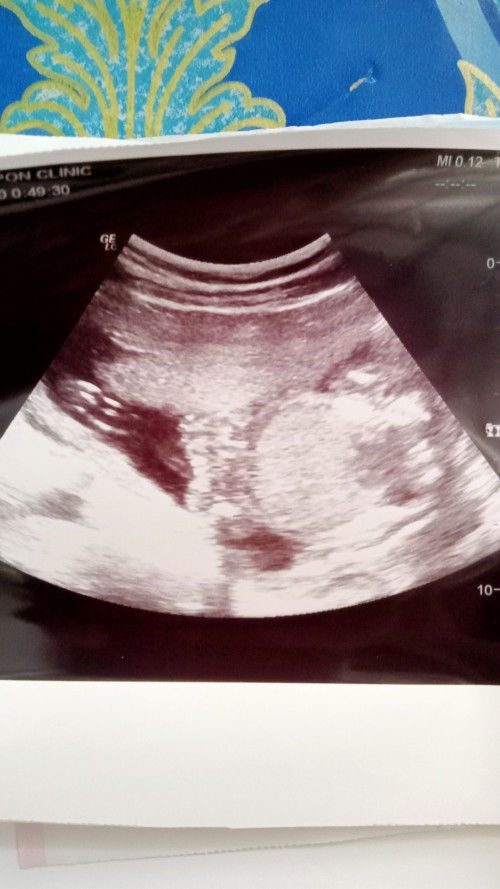 อัตราซาวด์เพศ