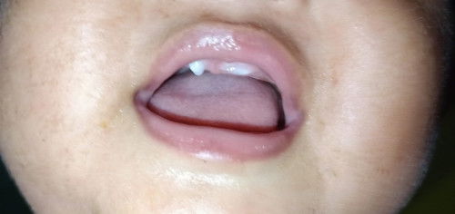 Gigi anak tumbuh lancip