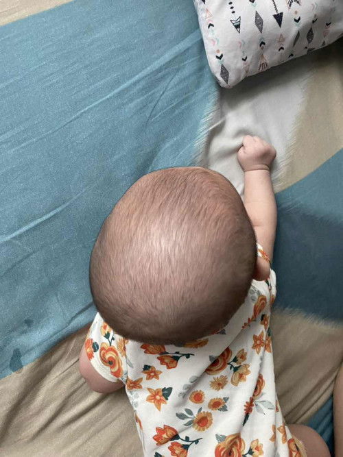 Kepala peyang bayi 3 bulan 22 hari