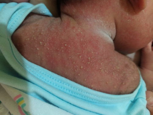 Buang keringat bayi 2minggu