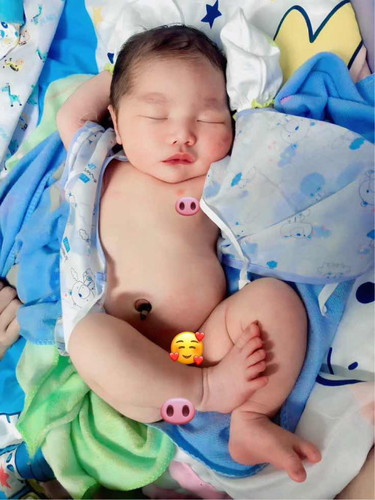 แอบแตกแล้วกำหนดคลอด12พฤศจิกายน
บล็อกหลัง+ผ่าคลอด+ทำหมัน