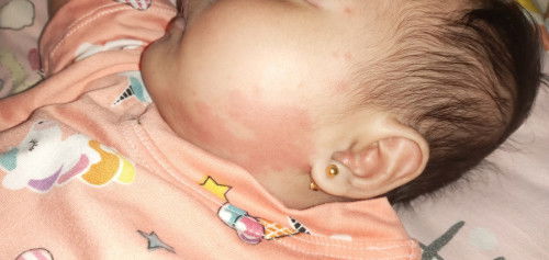 May pantal pantal po kasi si baby. Ask ko lang po kung ano ito?