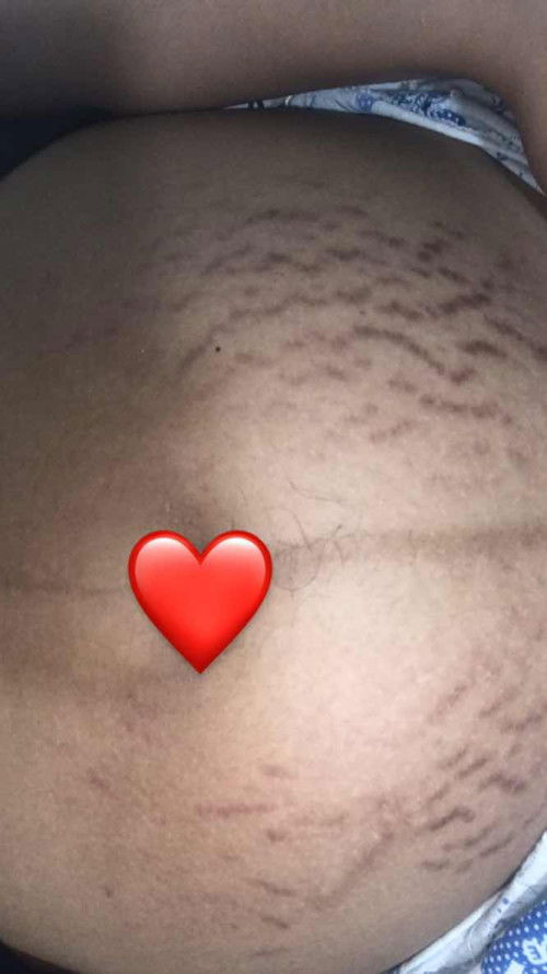 รอยเเตกลาย