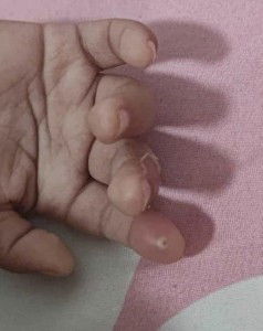 แม่ๆท่านไหนมีประสบการณ์ตุ่มแบบนี้ไหมคะ