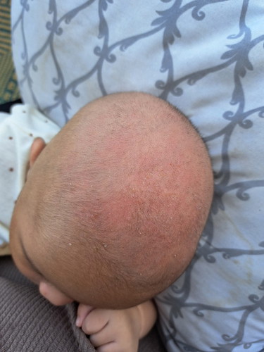 Kulit Kepala Baby
