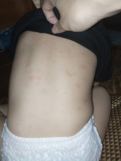 Bé nhà mk lúc 11th coá bị nổi nốt ở lưng ban đầu 2_3 nốt tưởg muỗi đốt .