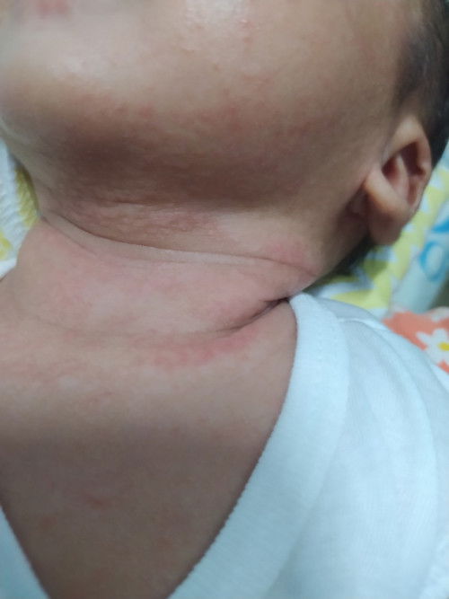 Remedies sa leeg ni baby