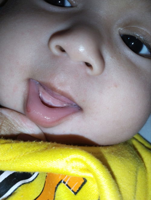 Gusi bayi ada putih-putih berbentuk gigi