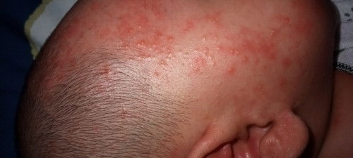 Bintik merah pada anak