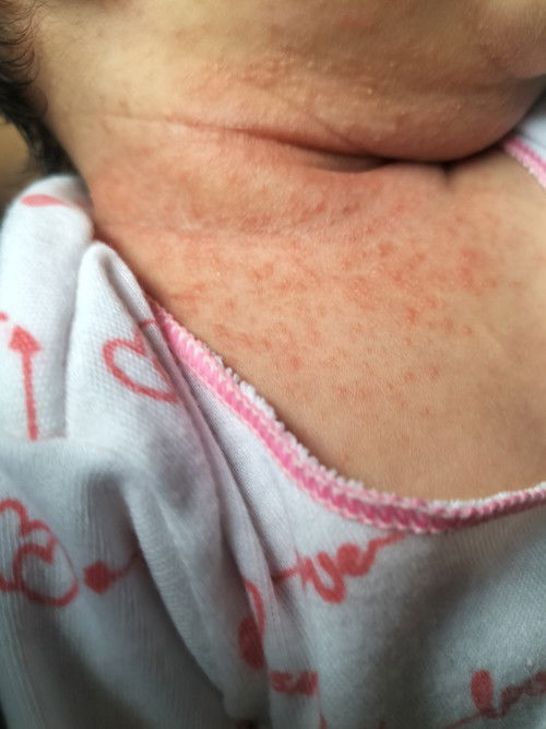 gimana ya cara menghilngkan bintik merah pada leher bayi,ada yang sama juga gak