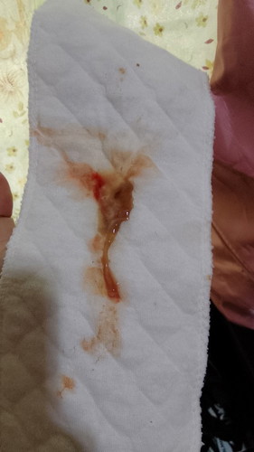 Mucus plug na ba ito?