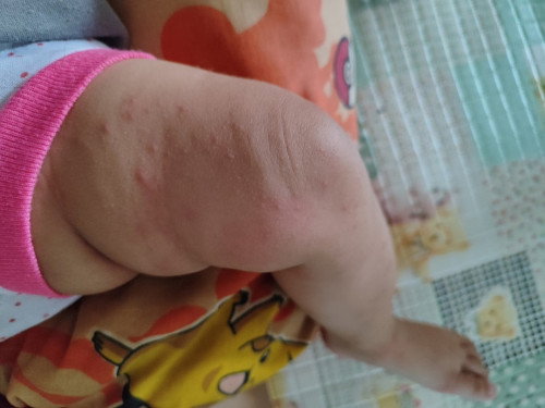 Biang Keringat atau Gatal Gatal
