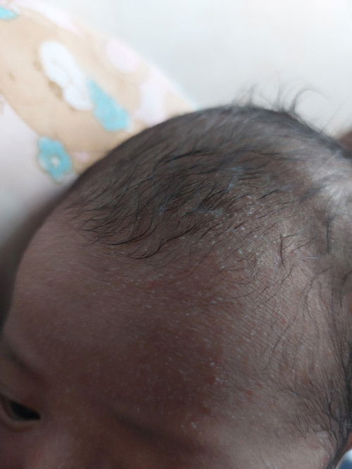 Baby umur seminggu ,ruam dileher dahi