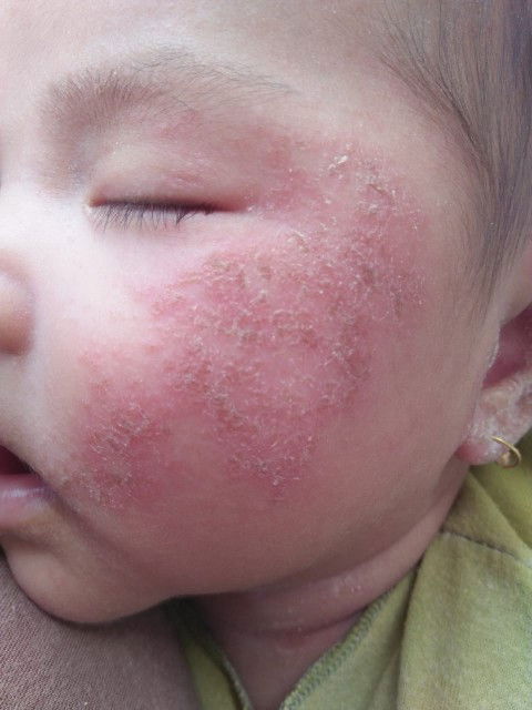 Itu ruam atau bukan ??