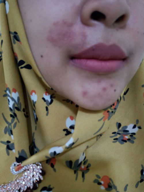 Ringwarm diwajah pd bumil