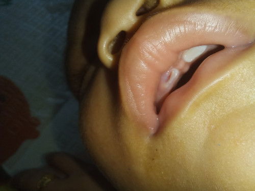 Gusi bayi luka bahaya kah?