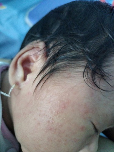 Các mom cho mình hỏi bé bị vậy là chadm sữa hay mụn sữa vậy ạ. Làm cách gì để bé nhanh hết