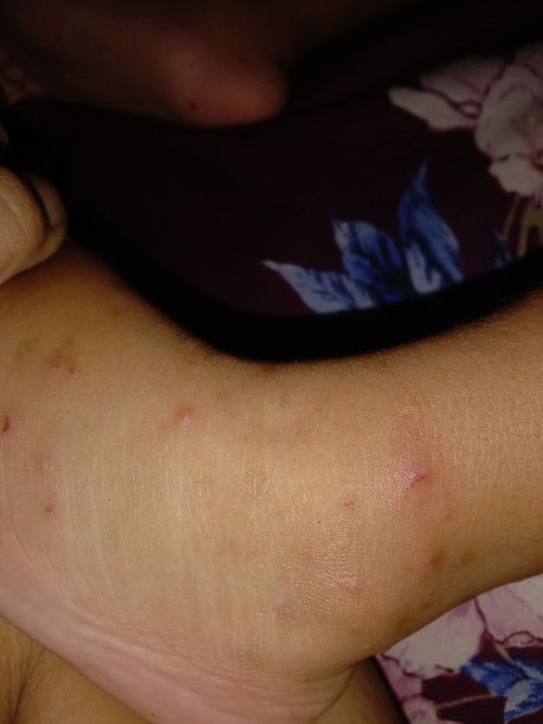 Info mengatasi gatal2 pada anak