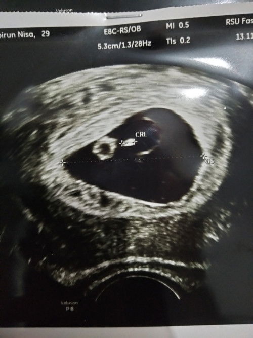 10weeks Janin tidak berkembang