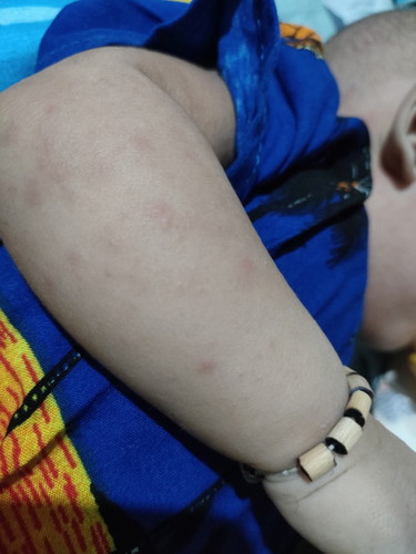Bintik² merah bun anakku 3 bulan akhir² ini sering bintik2 merah solilusi yg bisa di pakai pakai