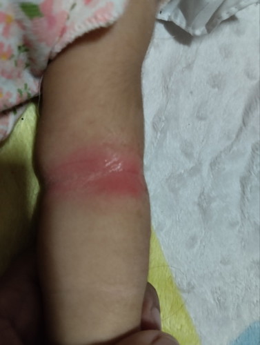 Rashes o redness sa katawan ni baby