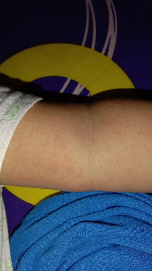 Merah merah di badan