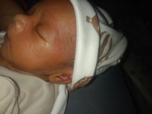 Moms kenapa ya di wajah anakku memerah dan ada bintik2 seperti jerawat berisi? Cara mengobatinya?