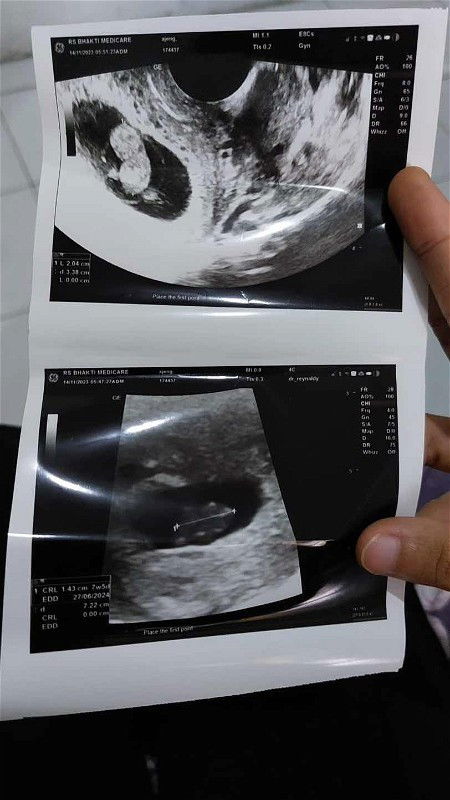 USG bulan kedua dinyatakan janin tdk brkembang