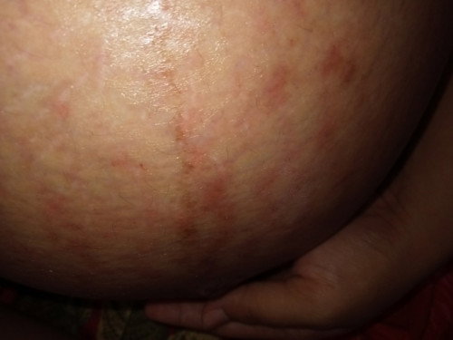 strech mark merah gatal