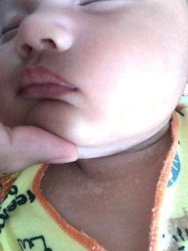 Leher bercak putih terus meluas