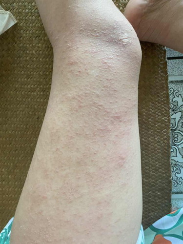 Em sinh xong bị ngứa nổi như này có cách nào hêt k ạ