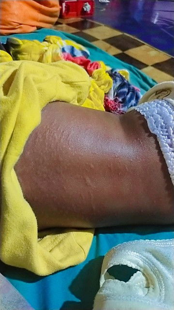 Gatal kalau di garuk jadi lebih banyak