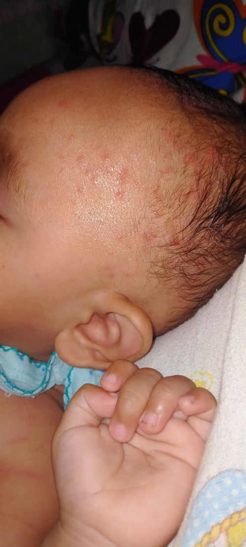Bentol merah pada jidad dan kepala anak
