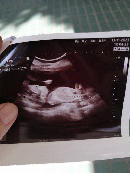 อาการไธรอยด์กลับมากำเริบ