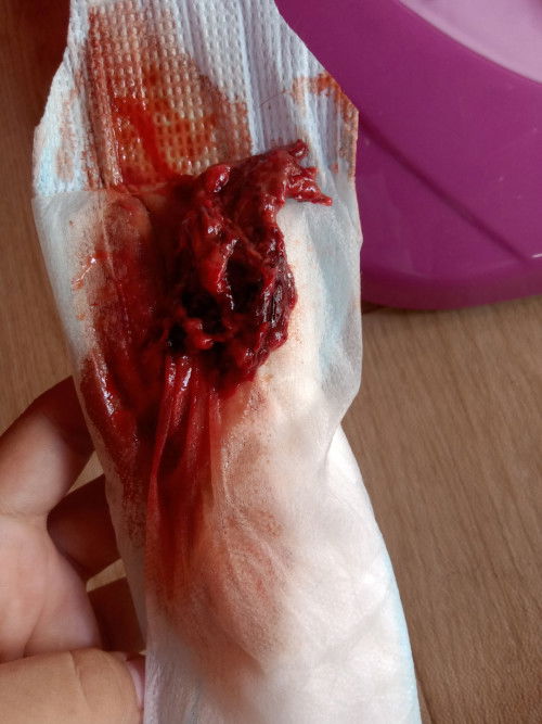 น้ำคาวปลาออกมาพร้อมก้อนเลือด