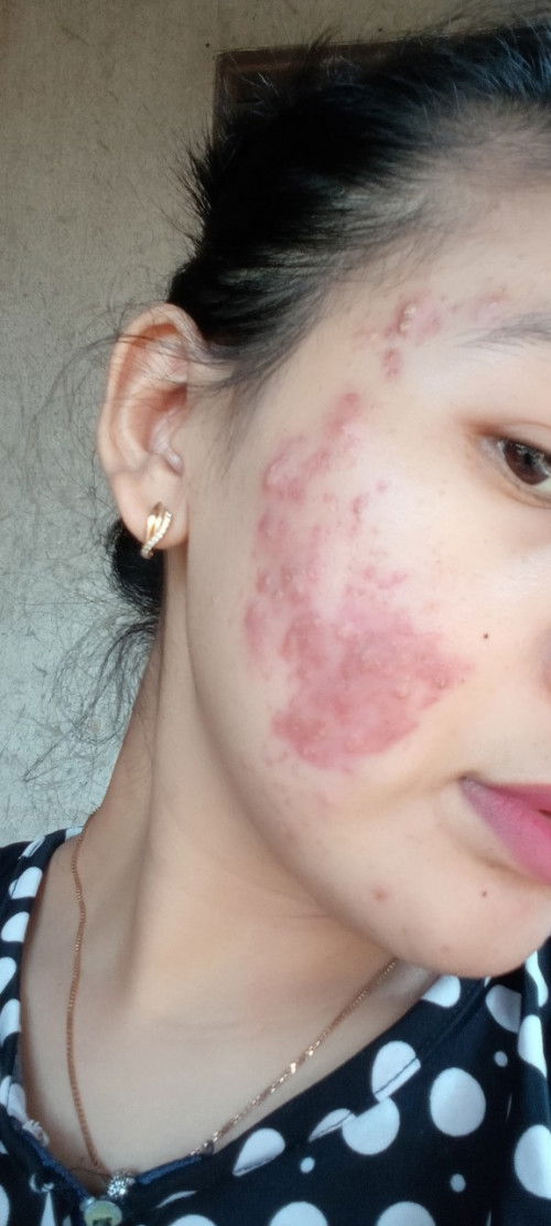 Jerawatan pas hamil dari bulan pertama kehamilan tapi sekarang udah 22 week udah mendingaan