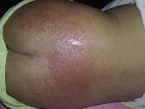 Ruam popok atau biang keringat