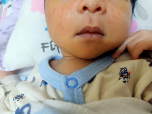 Bintik2 kat muka