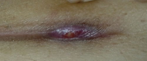 luka SC setelah 2 bulan basah dibagian kiri