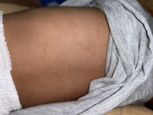 น้อง9เดือนพอเริ่มหายจากไข้ก็มีตุ่มมีผื่นขึ้นแบบนี้เลยค่ะ