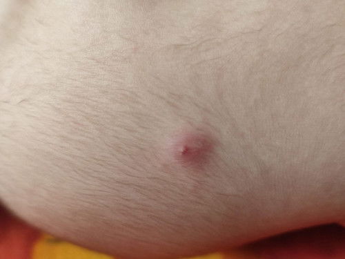 Bekas Suntikan Imunisasi