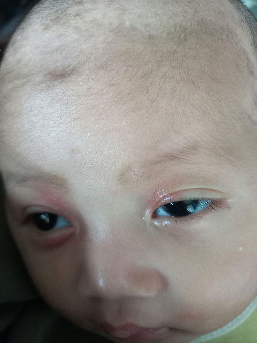 Kulit mata bayi merah